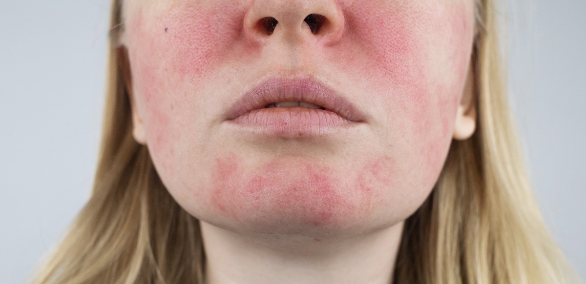 Symptoms And Treatment Of Atopic Dermatitis In Women